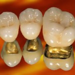 Captek Gold Crowns