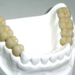 IPS Emax Impression