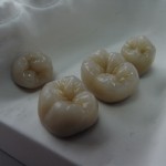 IPS e.max Single Crowns